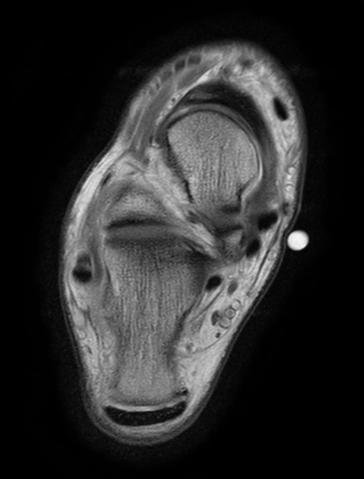 Axial T1w TSE - mDIXON XD (In Phase)<b>Post-gado</b>