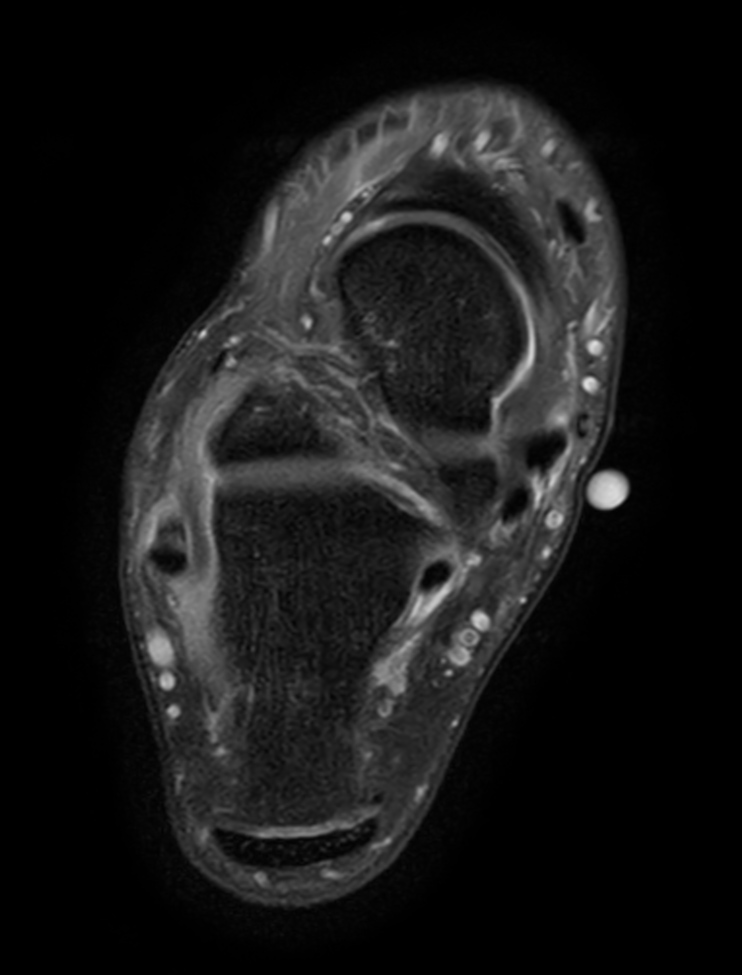 Axial T1w TSE - mDIXON XD (Water only)<b>Post-gado</b>