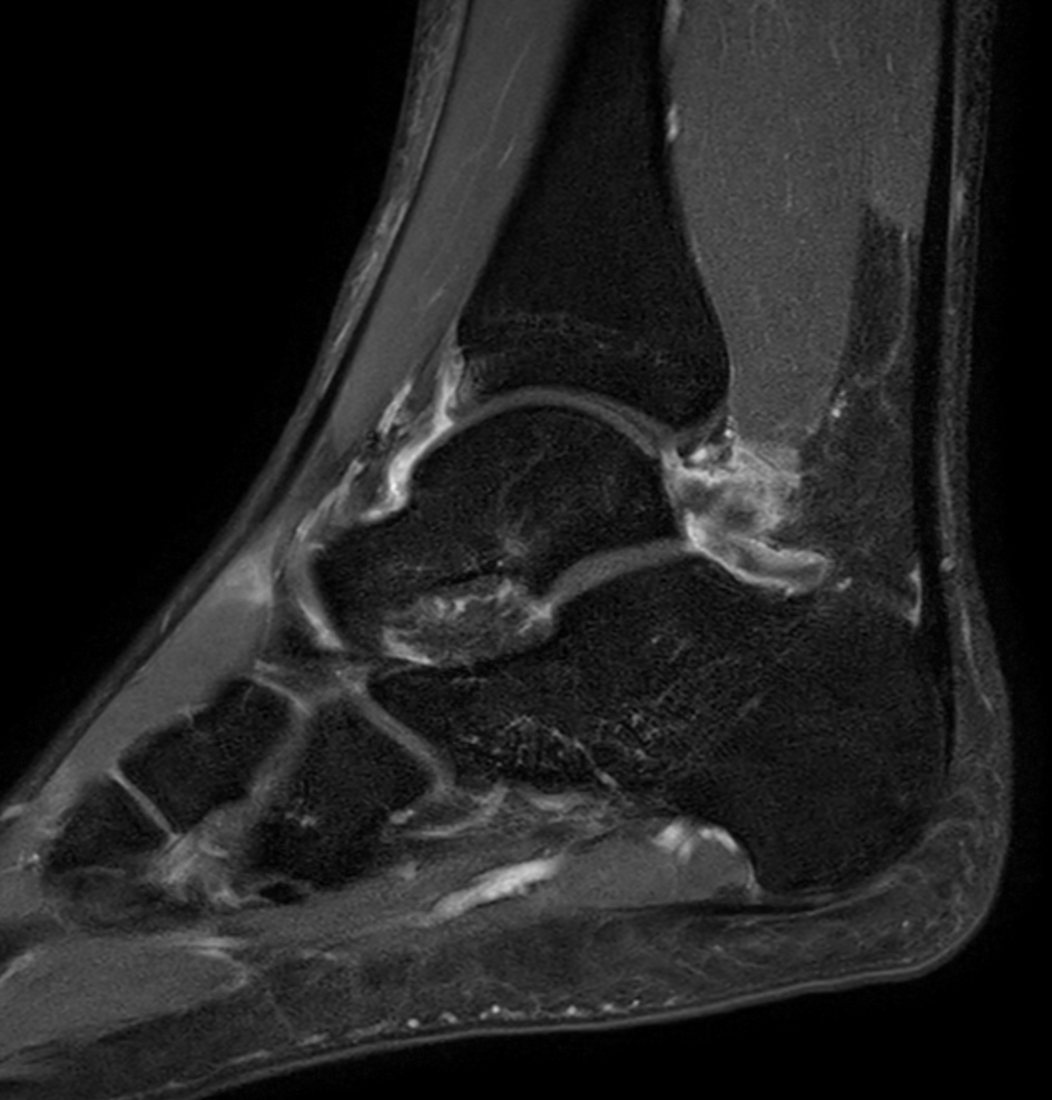 Sagittal T1w TSE - mDIXON XD (Water only)<b>Post-gado</b>