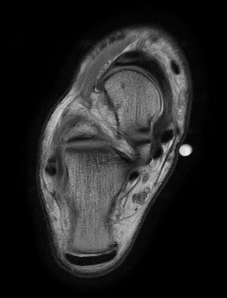 Axial PDw TSE - mDIXON XD (In Phase)