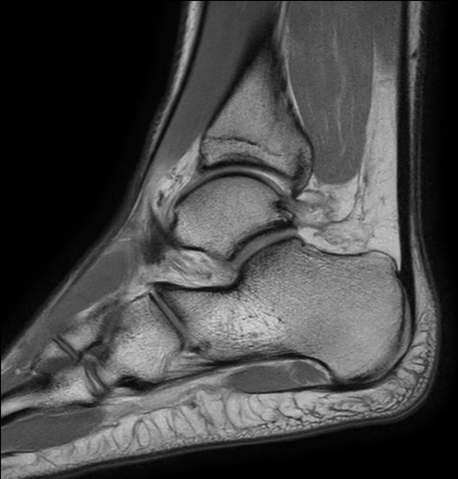 Sagittal PDw TSE - mDIXON XD (In Phase)