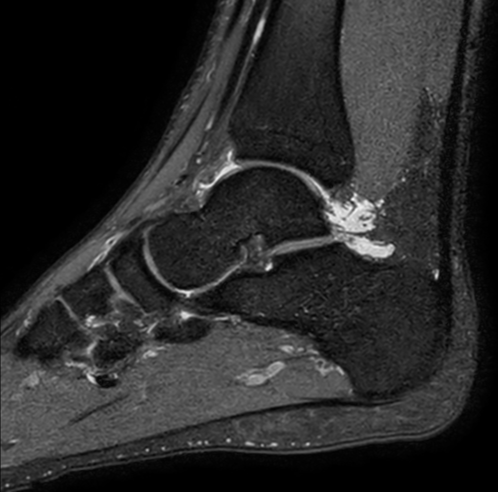 Sagittal 3D PDw SPAIR (0.5 mm, 7 min)