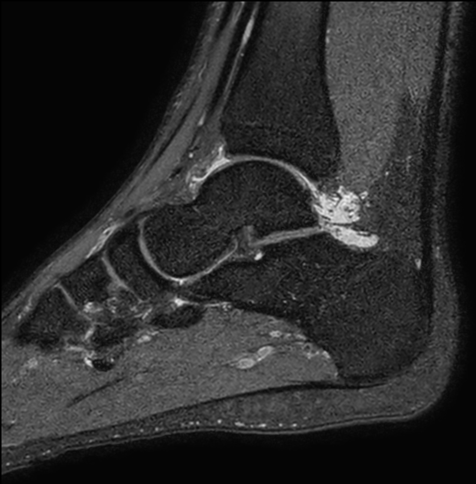 Sagittal 3D PDw SPAIR (0.5 mm, 5 min)