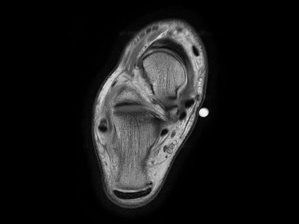 Axial T1w TSE - mDIXON XD (In Phase)<b>Post-gado</b>