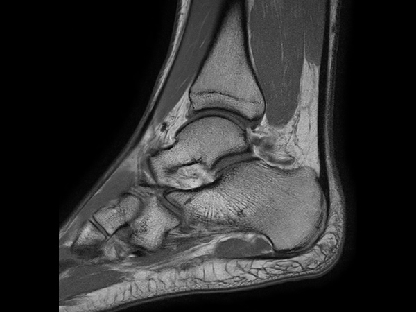 Sagittal T1w TSE - mDIXON XD (In Phase)<b>Post-gado</b>