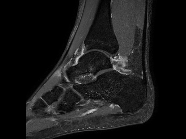 Sagittal T1w TSE - mDIXON XD (Water only)<b>Post-gado</b>