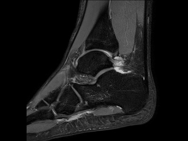 Sagittal PDw TSE - mDIXON XD (Water only)