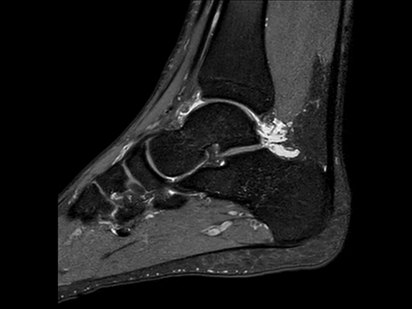 Sagittal 3D PDw SPAIR (0.6 mm, 7 min)