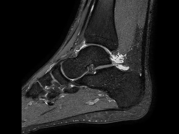 Sagittal 3D PDw SPAIR (0.5 mm, 7 min)