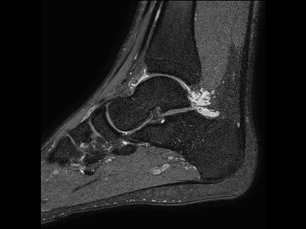 Sagittal 3D PDw SPAIR (0.5 mm, 5 min)