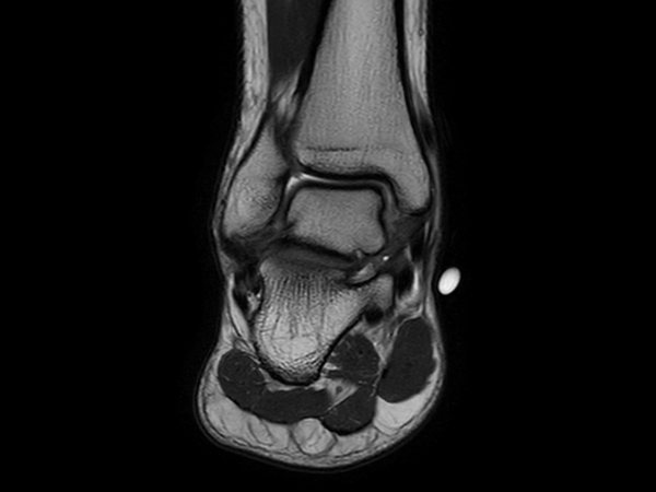 Coronal T2w TSE - mDIXON XD (In Phase)