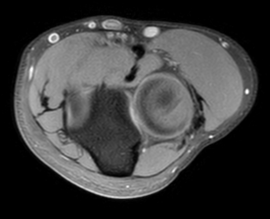 Axial T1w SPIR<b>Post-gado</b>