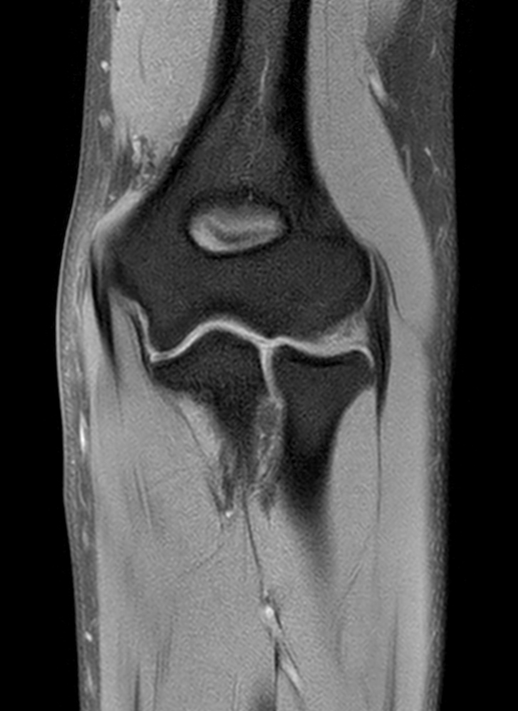 Coronal T1w SPIR<b>Post-gado</b>