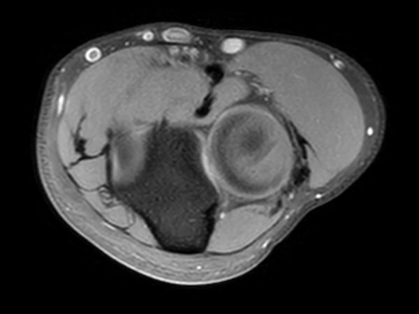 Axial T1w SPIR<b>Post-gado</b>