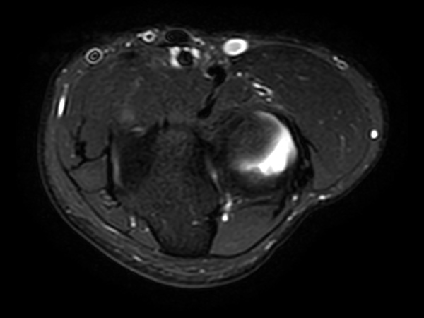 Axial STIR TSE