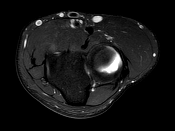 Axial T2w SPAIR