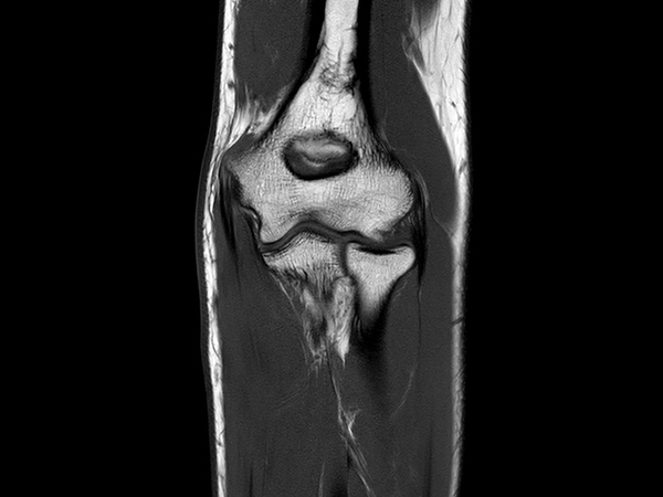 Coronal T1w TSE