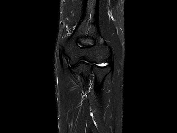 Coronal STIR TSE