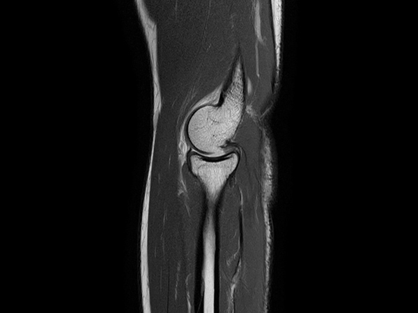 Sagittal PDw TSE