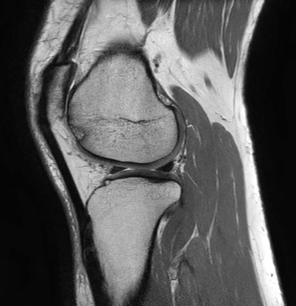 Sagittal PDw TSE