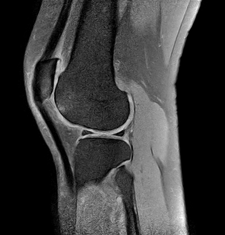 Sagittal T1w SPIR<b>Post-gado</b>