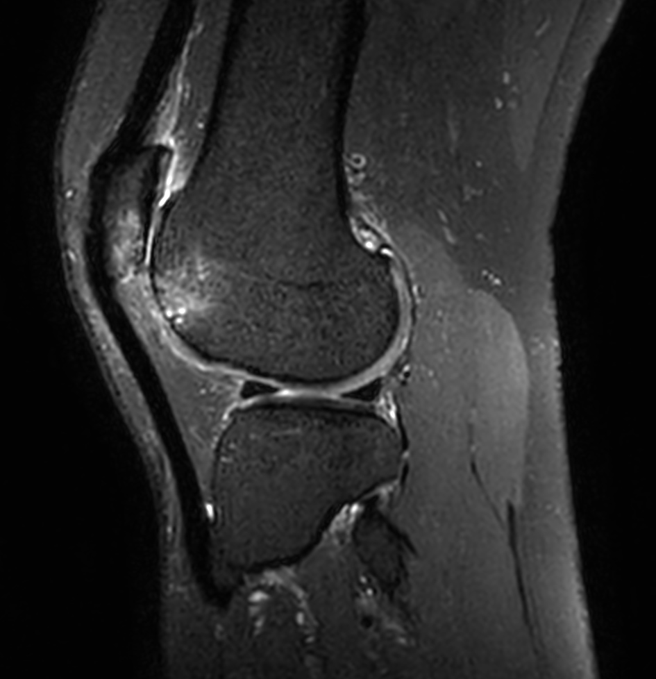 Sagittal 3D PDw SPAIR