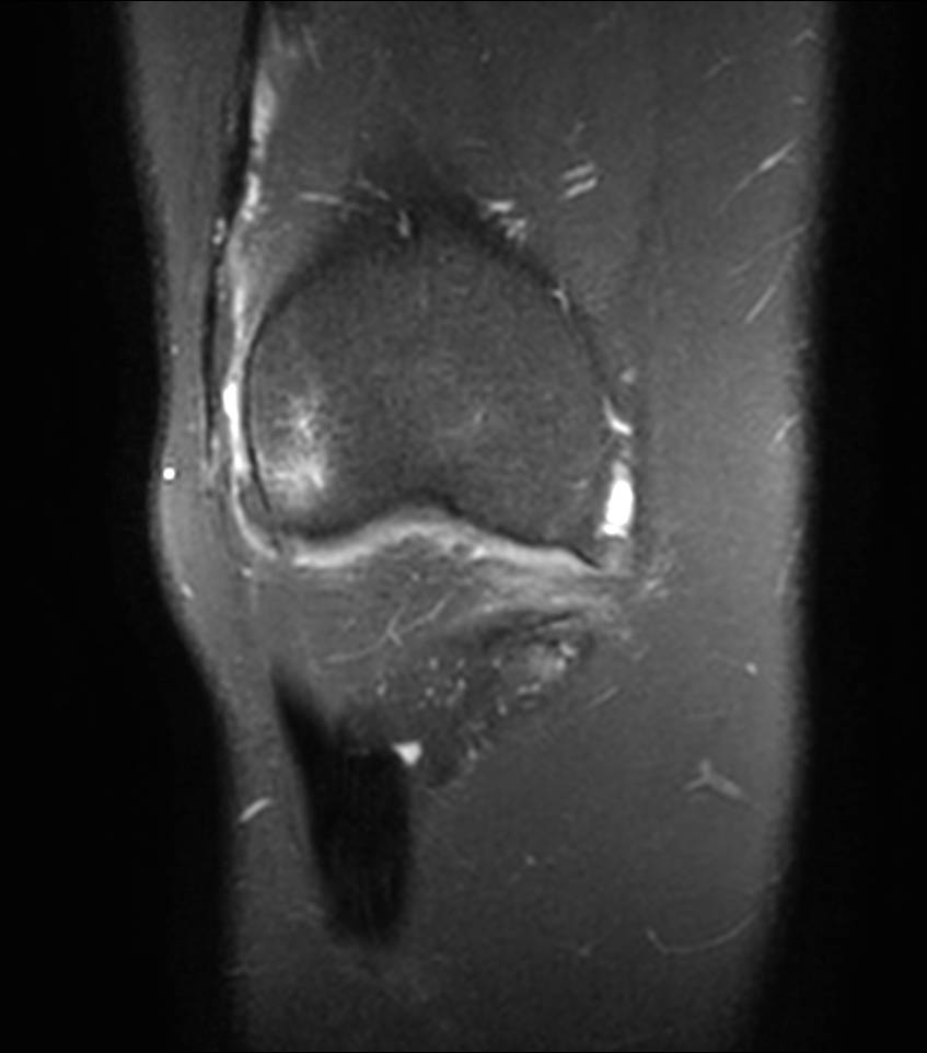 Coronal 3D PDw SPAIR (reformat)