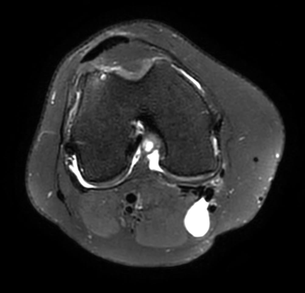 Axial 3D PDw SPAIR (reformat)
