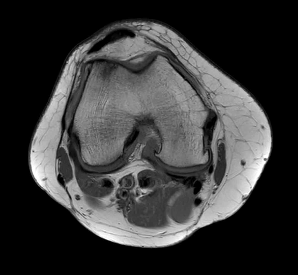 Axial T2w calc (source)