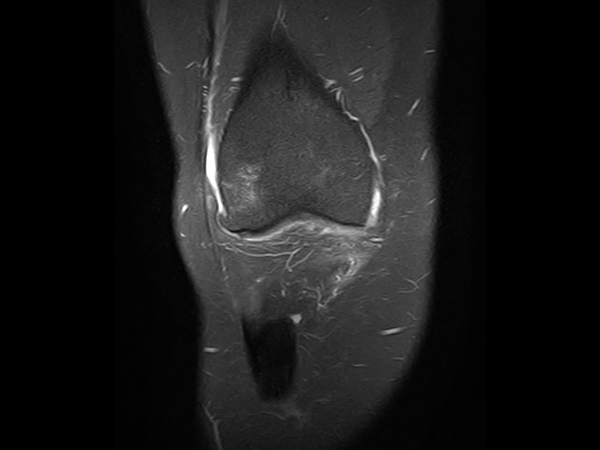 Coronal PDw SPIR