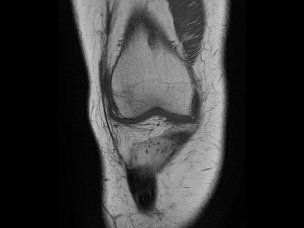 Coronal T1w TSE