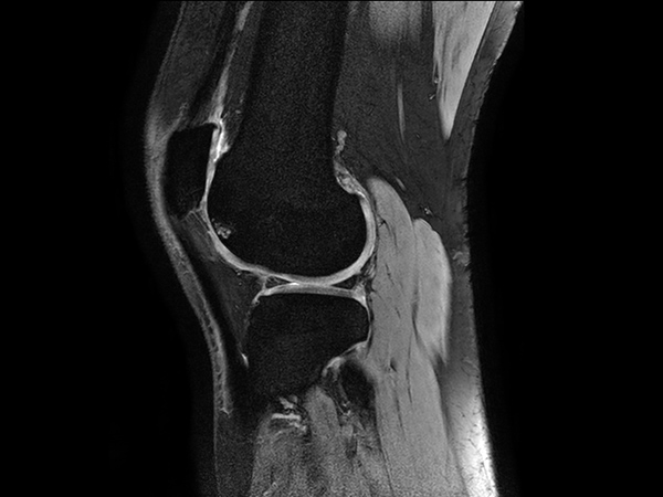 Sagittal 3D mFFE WATS