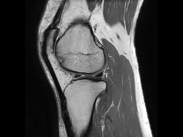 Sagittal PDw TSE