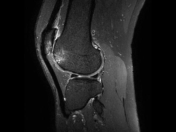 Sagittal 3D PDw SPAIR