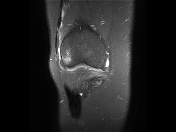 Coronal 3D PDw SPAIR (reformat)