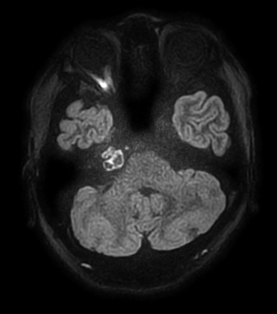 DWI TSE XD high res (b1000)