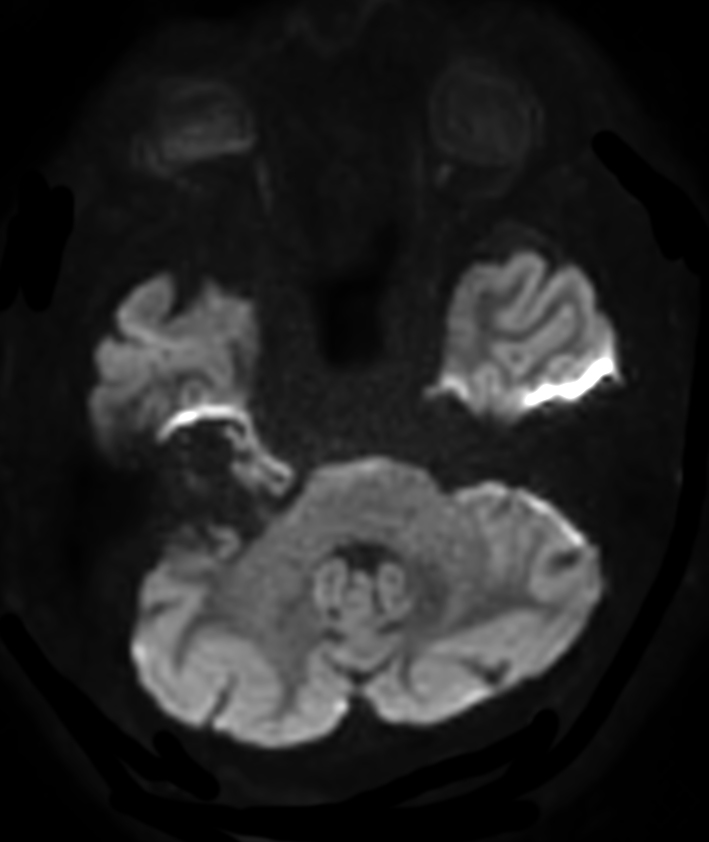 DWI EPI high res (b1000)