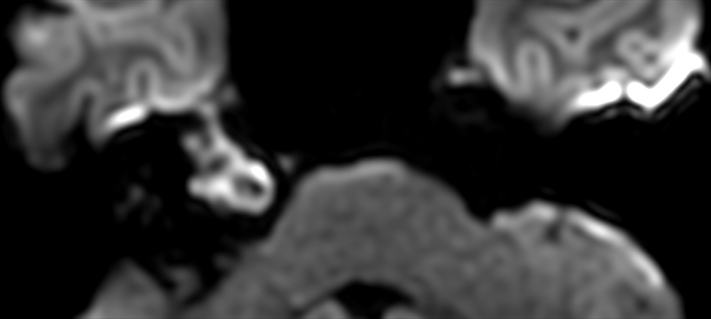 DWI EPI ZOOM (b1000)