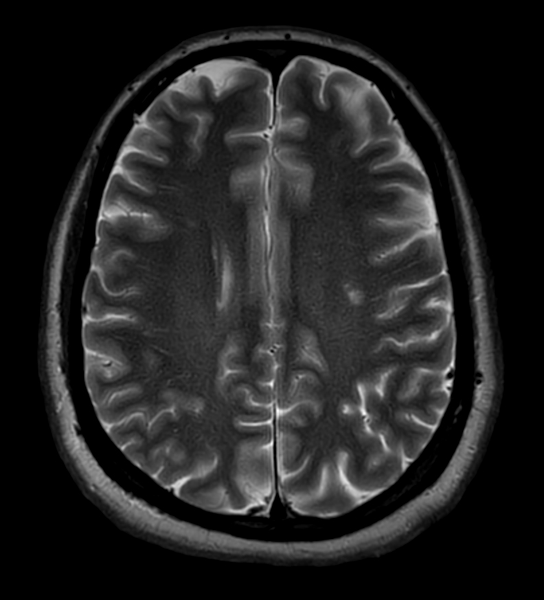 Axial T2w TSE MultiVane XD