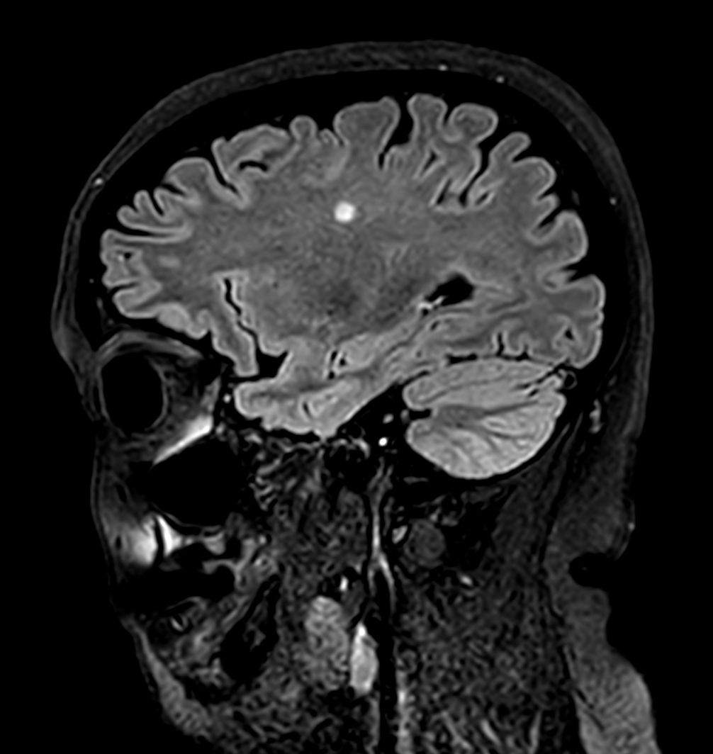 Sagittal 3D BrainVIEW FLAIR