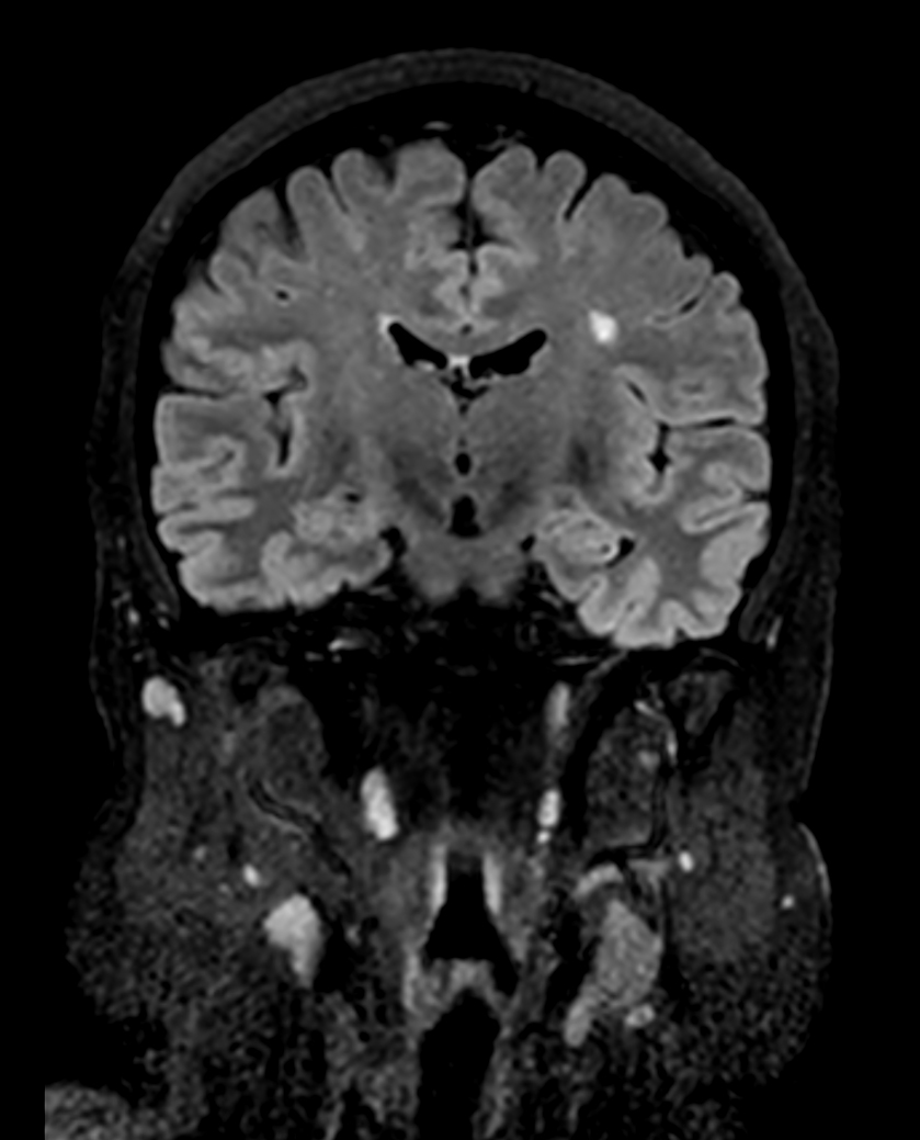 Coronal 3D BrainVIEW FLAIR (reformat)