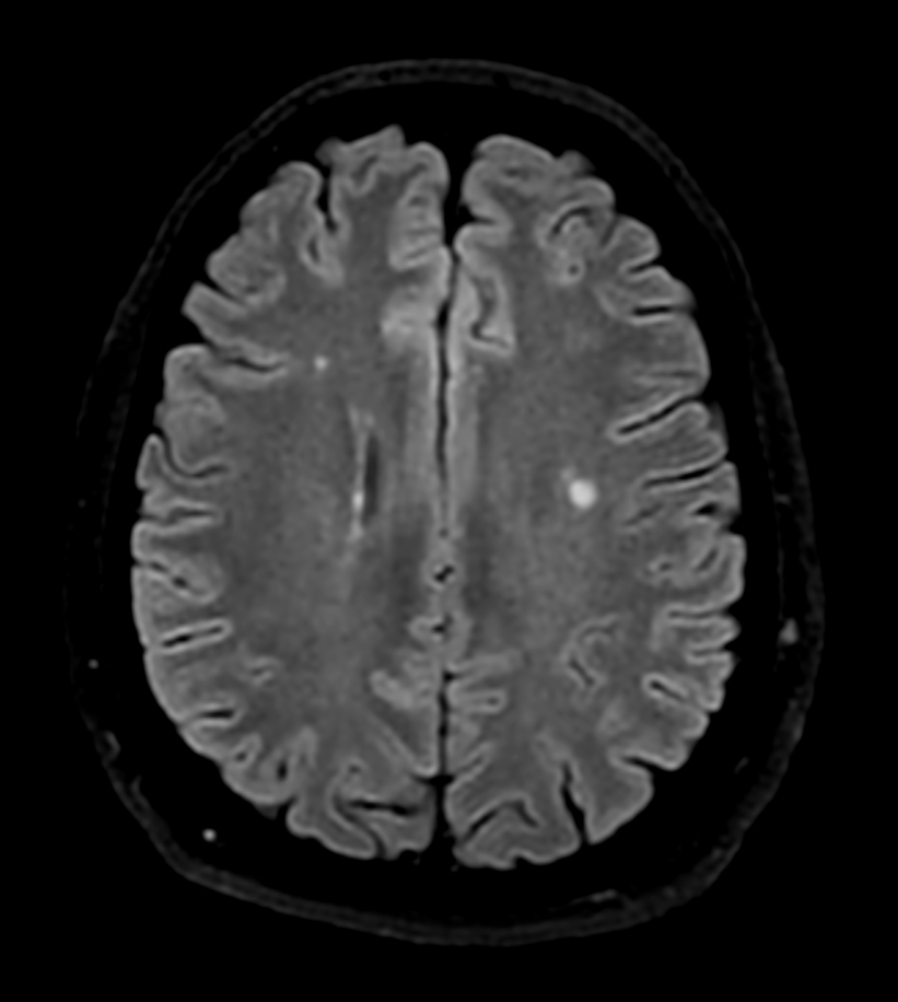 Axial 3D BrainVIEW FLAIR (reformat)