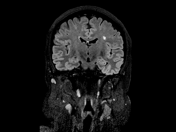 Coronal 3D BrainVIEW FLAIR (reformat)