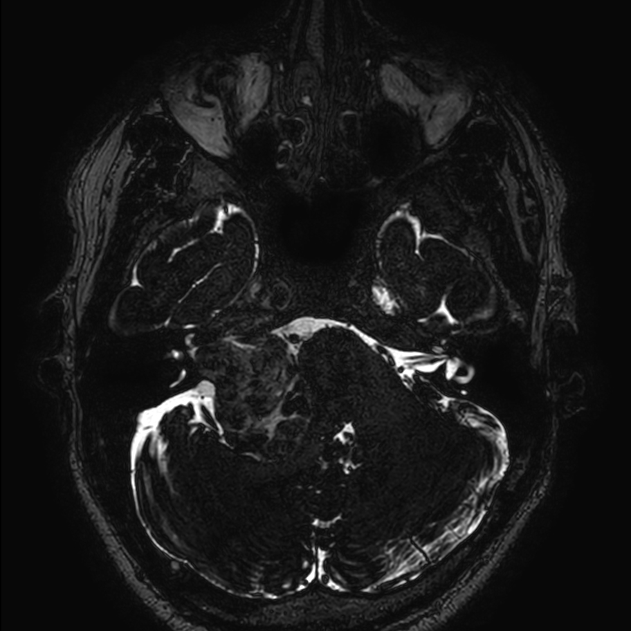 Axial 3D T2w TSE DRIVE