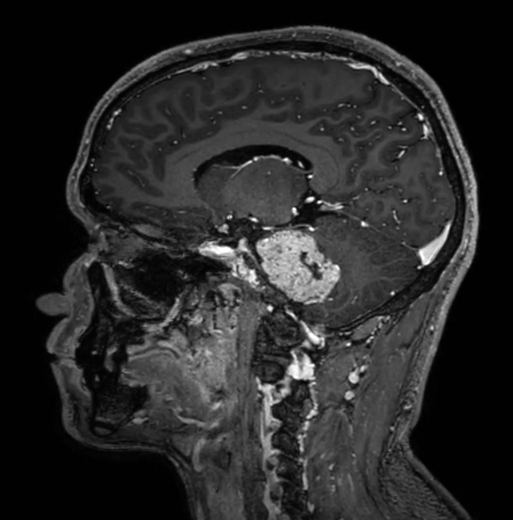 Sagittal 3D T1w TFE BrainVIEW with gado