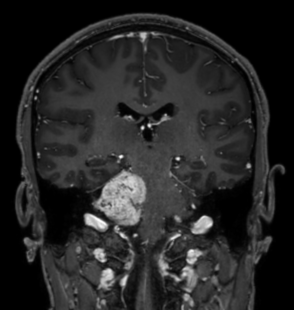 Coronal 3D T1w TFE BrainVIEW with gado (reformat)