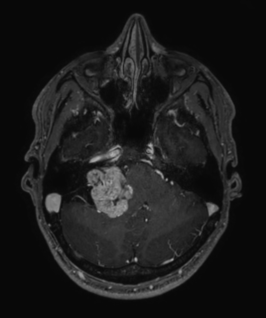 Axial 3D T1w TFE BrainVIEW with gado (reformat)