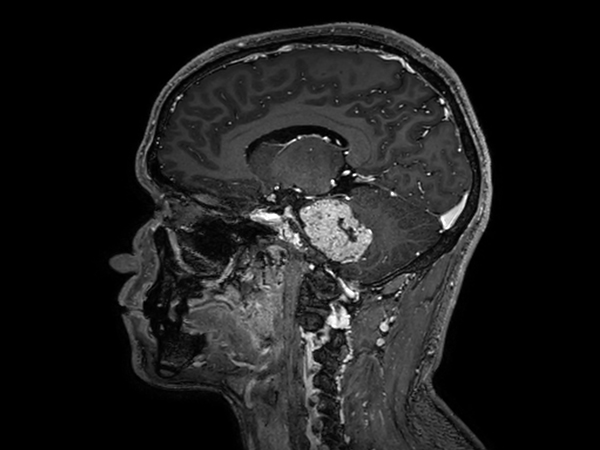 Sagittal 3D T1w TFE BrainVIEW with gado