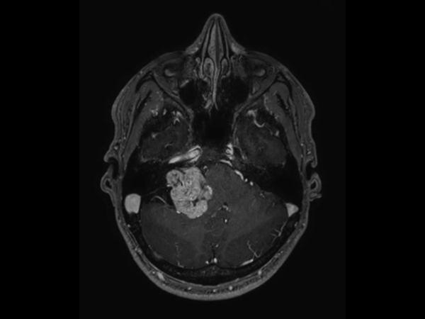 Axial 3D T1w TFE BrainVIEW with gado (reformat)