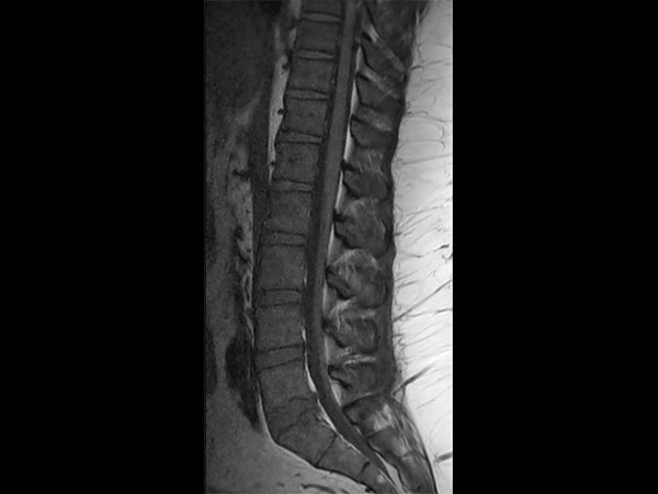 Sagittal T1w TSE pre-gado